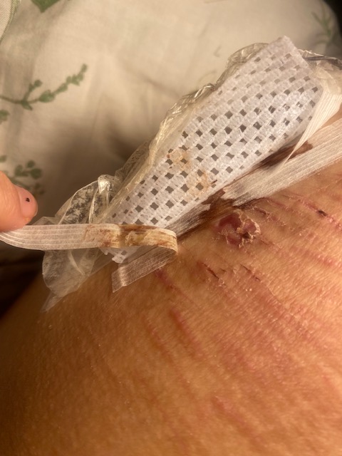 chihguiehs70992's tweet image. this is the second time the hospital gave me an infection like theres pus and one literally js burst with water thing
#shtwt #infection