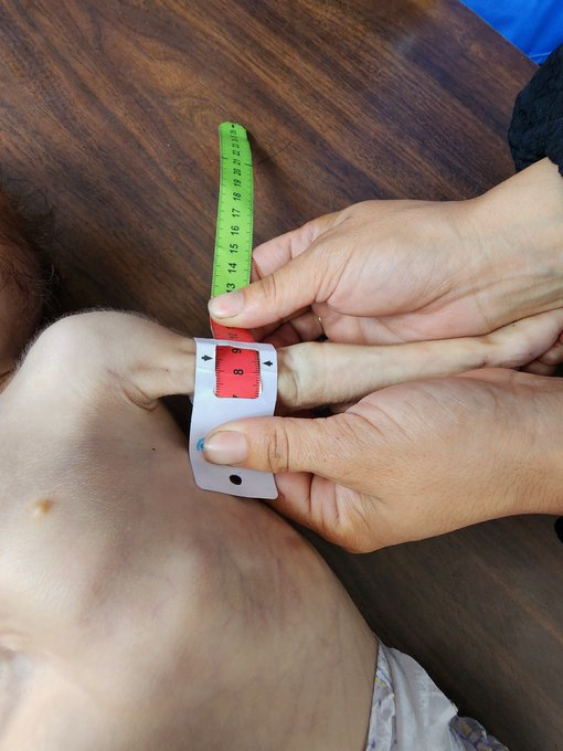 SaveSJarrah's tweet image. #GazaGenocide, 19 Apr 2026
UNRWA says child malnutrition cases in Gaza are rising again as the U.S. and Israel continue to severely restrict basic humanitarian aid to Gaza:
#NetanyahuWarCriminal #Boycottisrael
#TrumpWarCriminal #BoycottUSA