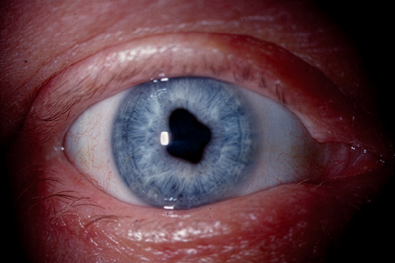 revoptom's tweet image. Higher Blood Sugar Increases Anterior Uveitis Risk, Research Says

The finding affects both type 1 and 2 diabetes patients, and those with poorly controlled HbA1c in all demographics.

reviewofoptometry.com/article/higher…

#optometry #optometrist #eyecare #uveitis #highbloodsugar