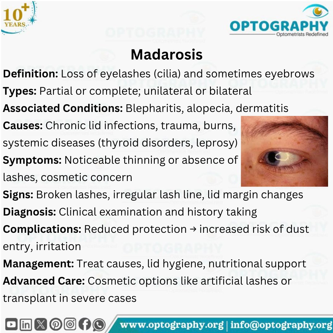 Optography8's tweet image. Loss of lashes isn’t just cosmetic — Madarosis can signal deeper eye or systemic issues. Diagnose early, treat smart.
#Madarosis #Optometry #Optography #Thatoptometrist #Eyelashes