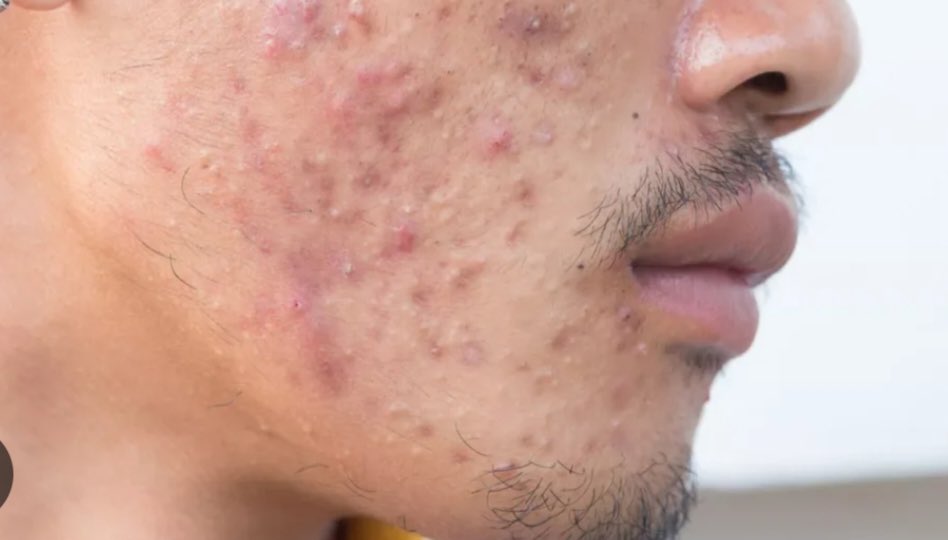 QemyChipsmore's tweet image. 🖌️INFO🧰 Jerawat  pada pesakit positif HIV tidak berjangkit (bukan penularan virus HIV) melalui sentuhan biasa. HIV hanya berjangkit melalui cecair badan (darah, air mani, cecair faraj, dan susu ibu)✌️ #plhv #hiv #aids #lgbtq