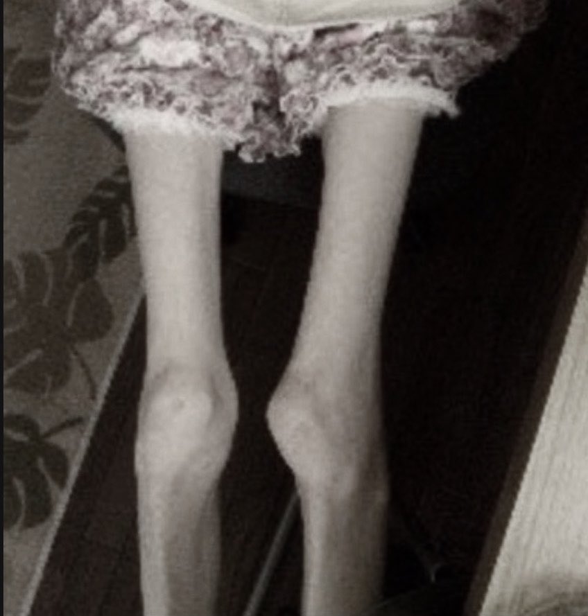 dollsizedangel's tweet image. 🦴leg bonespo🦴 #perfect #thin #ed #thinspo #bonespo #shedtwt