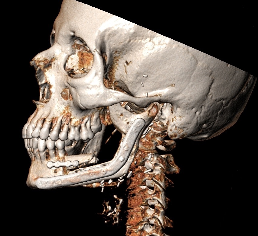 DTJournal1's tweet photo. The “Beveled One-and-a-Half-Barrel” Fibula Transplant with Virtual Surgical Planning and CT-Guided Implant Surgery for Prosthetic Rehabilitation in Posterior Mandible Defects: A Pictorial Essay (Massarelli &amp; Meloni, 2022). https://t.co/CPDRSv0yJb

#fibula https://t.co/IOZaQZUnFJ