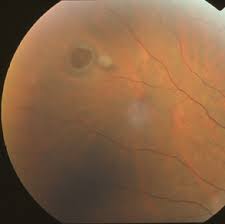 drgunjand's tweet image. What is the retinal lesion?

#MedTwitter #ophthalmology #neetpg 
Image @revoptom