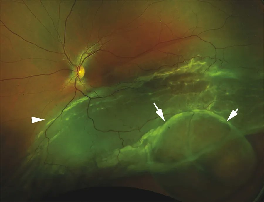 drgunjand's tweet image. 32 year old male presents with blurred vision in his left eye following a blunt trauma. 

What is the lesion?

#MedTwitter #ophthalmology #neetpg
Image Ento Key