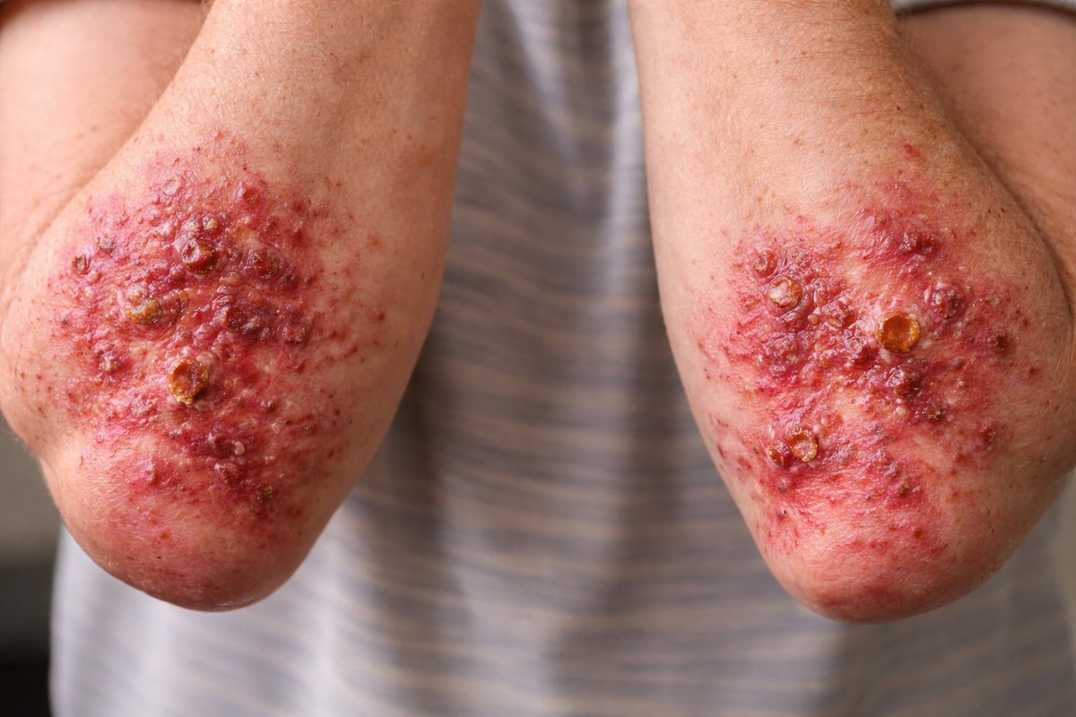 IhabFathiSulima's tweet photo. History of Chronic Diarrhoea.
What is the diagnosis? https://t.co/6FUUgfiqlZ