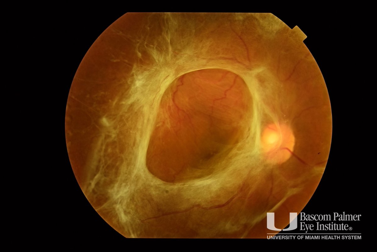 drgunjand's tweet image. What is the type of retinal detachment seen here?

#MedTwitter #ophthalmology #neetpg 
Image @BascomPalmerEye