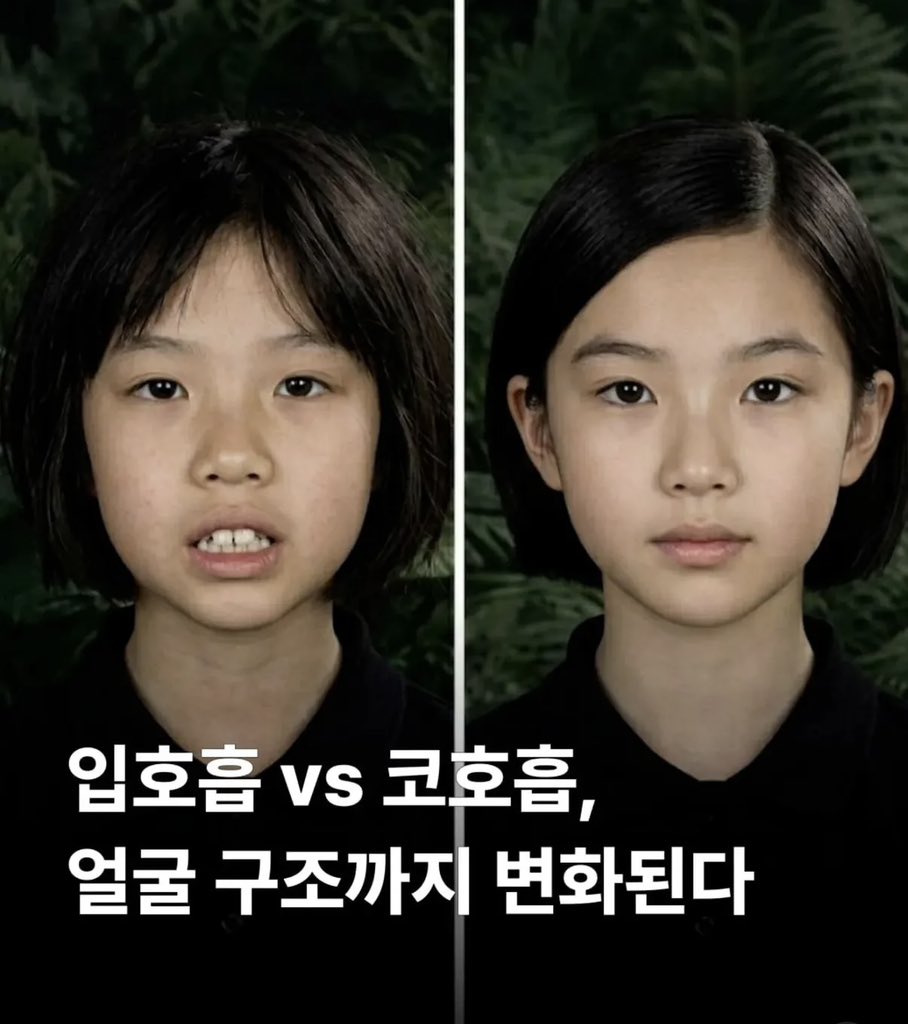 코호흡이 중요한 이유
특히 성장기에는 혀 위치와 턱정렬이 매우 중요한데 코로 숨쉬는 것은 혀가 자연스럽게 천장에 위치하게 해줘 얼굴의 균형을 잡아준다.