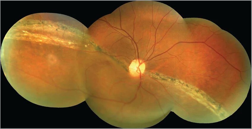 drgunjand's tweet image. 62 year old woman comes for evaluation of blurred vision in her right eye for the last 5 months.

#MedTwitter #ophthalmology #neetpg 
Image @ResearchGate