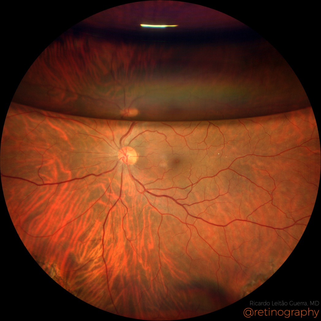 drgunjand's tweet image. Are there 2 optic discs in this eye?

#MedTwitter #ophthalmology #neetpg
Image @retinography