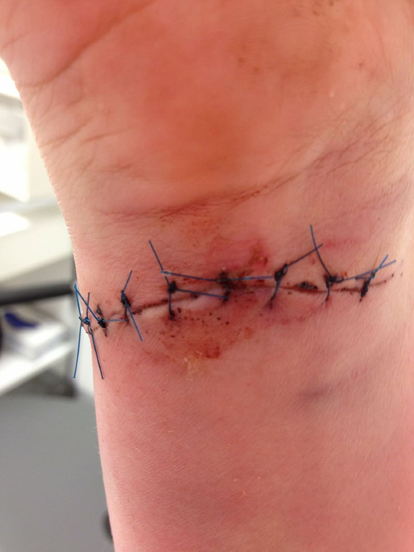 BVMurciasalud's tweet photo. #Preevid
Los puntos de #sutura y las #grapas, ¿se deberían quitar alternos o todos a la vez?
🔶Depende de varios factores: espesor de epidermis, tensión de la herida..
🔶2 manuales: si hay duda, retirar de forma alterna en vez de quitarlos de una vez
👉 https://t.co/RQ9Ko0znWE https://t.co/O3QWzrQcNz