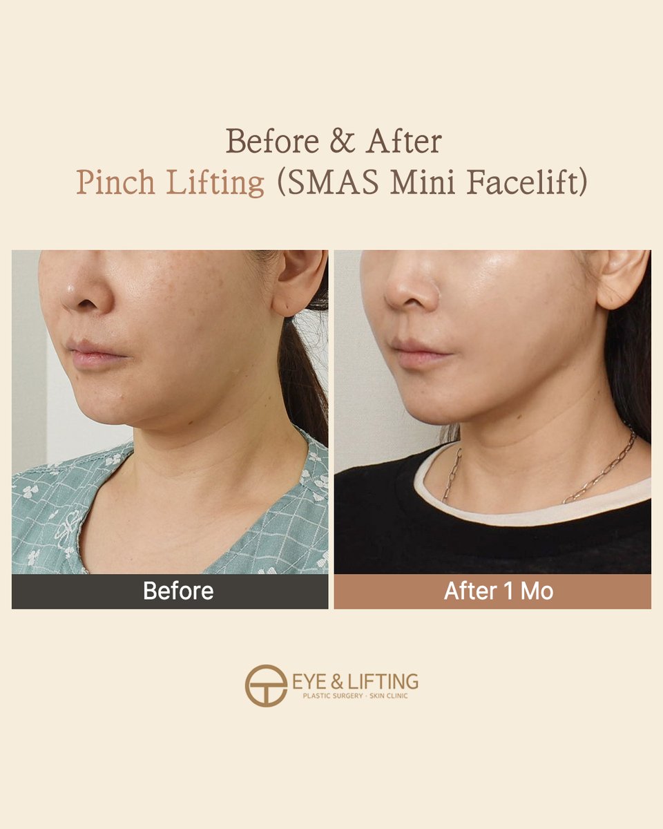 EyeLiftingPS's tweet photo. Minimal Incision, Maximum Results! ✨

Wide SMAS dissection reaching the mouth &amp; nasolabial area for a seamless lift.

⏳ Recovery: Just 2 weeks!

Say goodbye to sagging, hello to your youthful beauty transformation. 🕊️ https://t.co/1PbTltLWf4