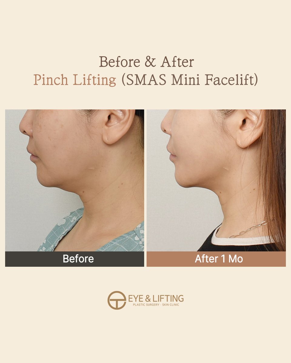 EyeLiftingPS's tweet photo. Minimal Incision, Maximum Results! ✨

Wide SMAS dissection reaching the mouth &amp; nasolabial area for a seamless lift.

⏳ Recovery: Just 2 weeks!

Say goodbye to sagging, hello to your youthful beauty transformation. 🕊️ https://t.co/1PbTltLWf4