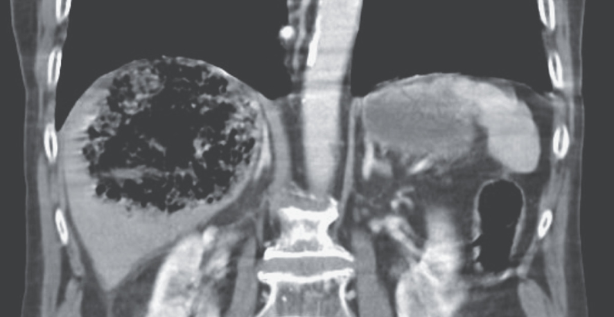 guerreroespejo's tweet image. 82-YO man, diabetes, chronic pancreatitis, &amp;amp; biliary strictures: fever, confusión &amp;amp; the R upper quadrant of the abdomen tender to palpation.

CT large area of gas in the right hepatic lobe
½

@AlexBofill and Marco F
DOI: 10.1056/NEJMicm2108779
#MedEd #medicine