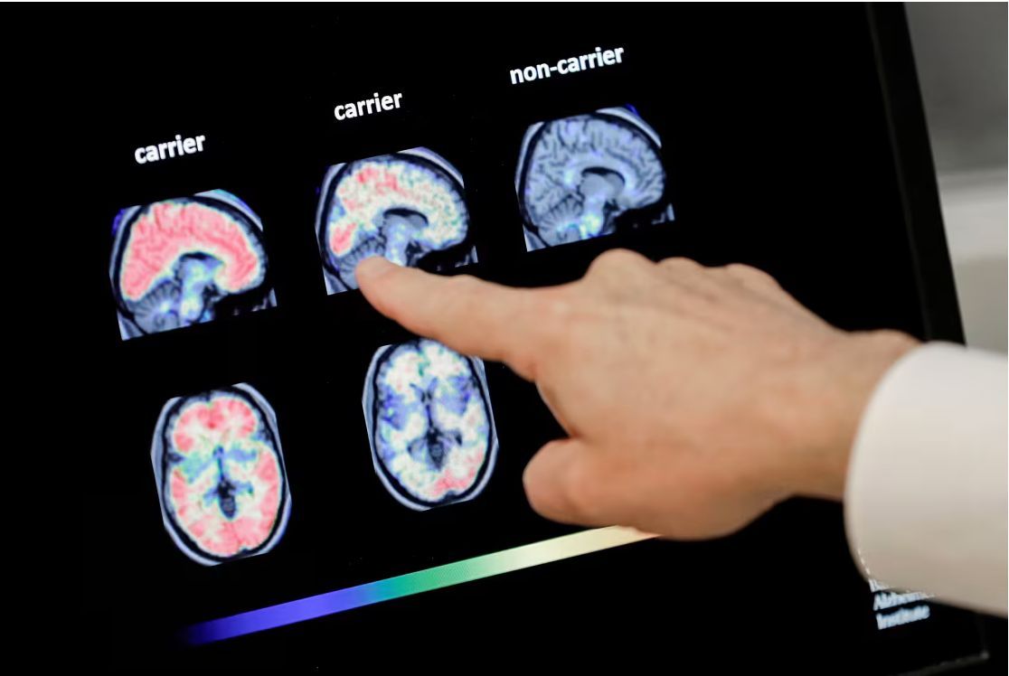 GracePointeHC's tweet photo. We may have a simple blood test to detect Alzheimer’s soon. https://t.co/dWvgxEiRNm https://t.co/hVDTqTYzWL