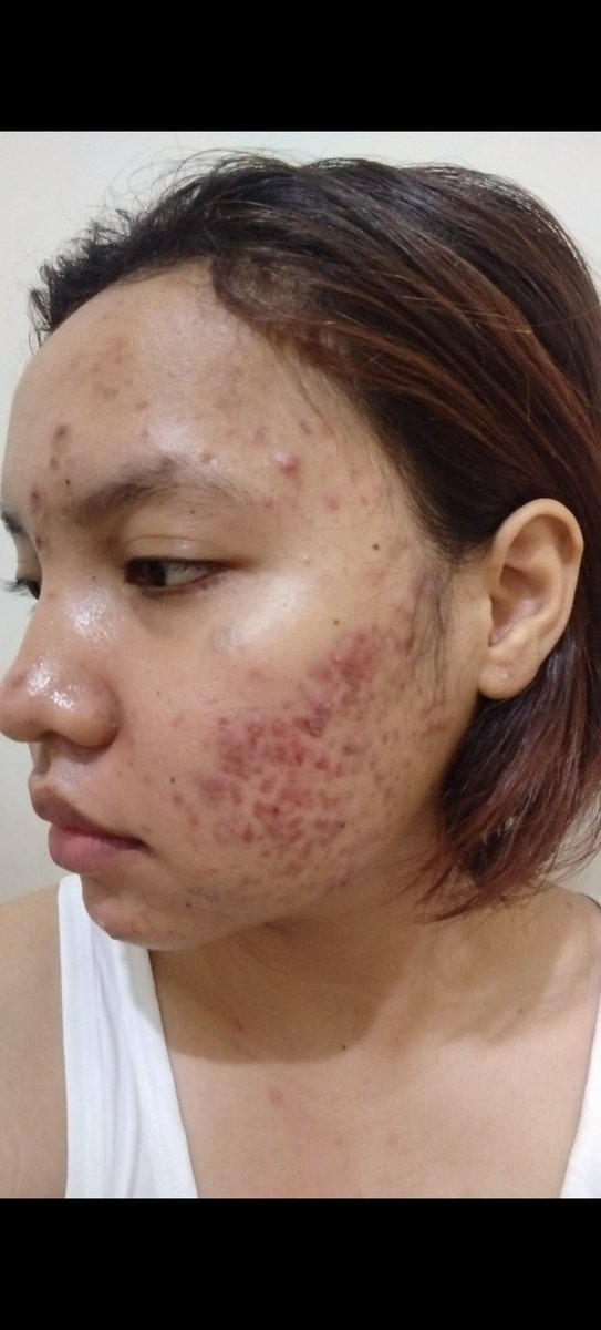 bebekkkk1666's tweet image. GUYS AKU MAU SPILL PERJUANGAN AKU SEBAGAI ACNE FIHTER!!! 
#Acnefighter #SpillSkinCare #Acne #viral

  FROM THIS          TO THIS