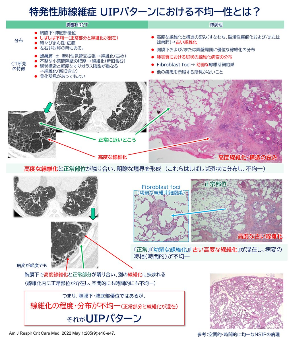🫁間質性肺疾患：UIPの不均一性とは？

指導医
「若手に、UIPパターンを解説するぞ！
IPFや線維化性肺疾患で重要な画像・病理パターンなんだぜ！」

【UIPパターンの特徴】
・両側下葉 / 胸膜下優位
・蜂巣肺
・牽引性気管支拡張
・正常肺と線維化が混在する“不均一性”

専攻医A