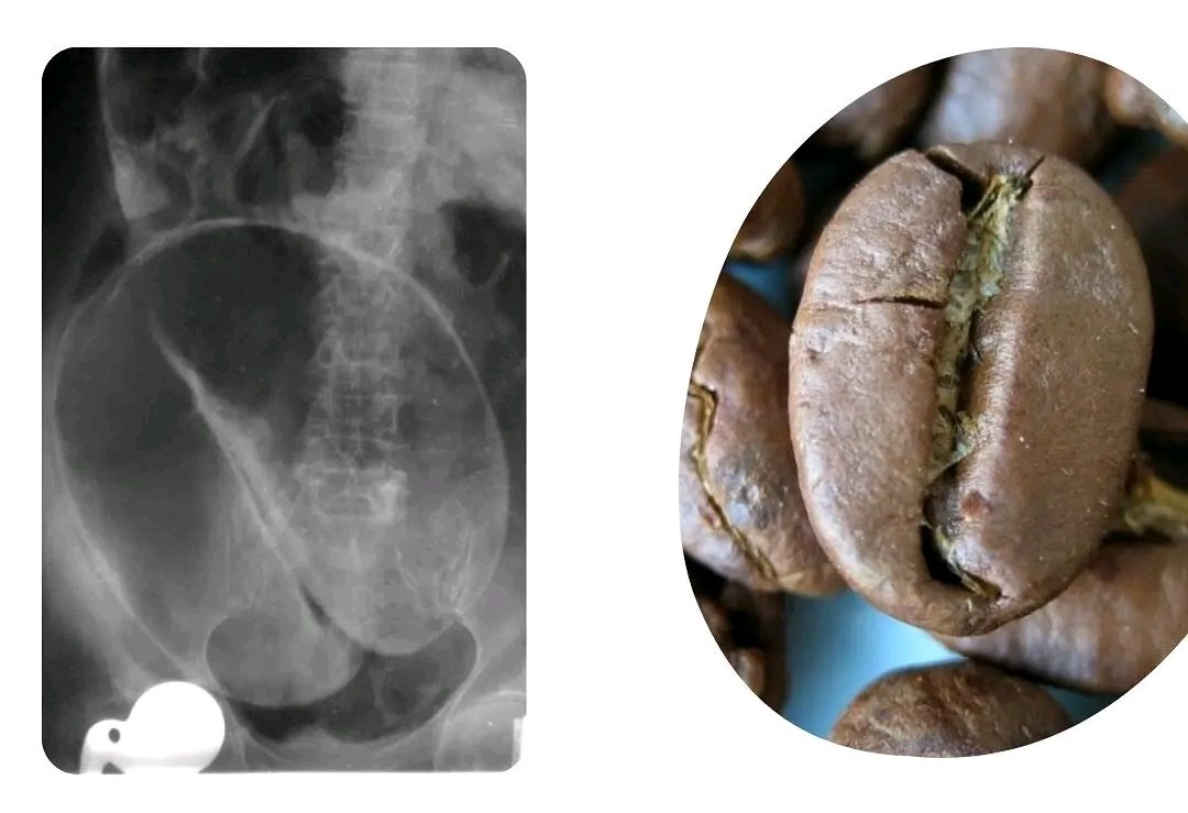 Doctors_GUILD's tweet photo. Coffee bean sign is seen in?

a) Gastric volvulus
b) Sigmoid volvulus
c) Hypertrophic pyloric stenosis
d) Midgut volvulus https://t.co/JjjQ9fkwuo