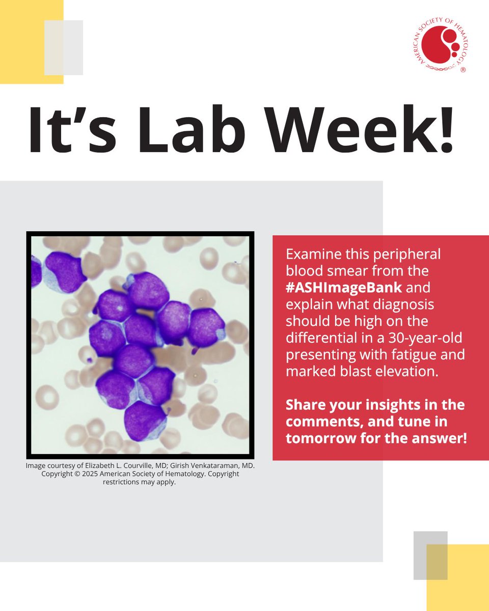 ASH_hematology's tweet photo. It’s #LabWeek! Examine this peripheral blood smear from the #ASHImageBank and explain what diagnosis should be high on the differential in a 30-year-old presenting with fatigue and marked blast elevation. 

Check back Wednesday for the answer! 

#Hematology  #Leusm #ASHEducation https://t.co/YnPabuDlAl