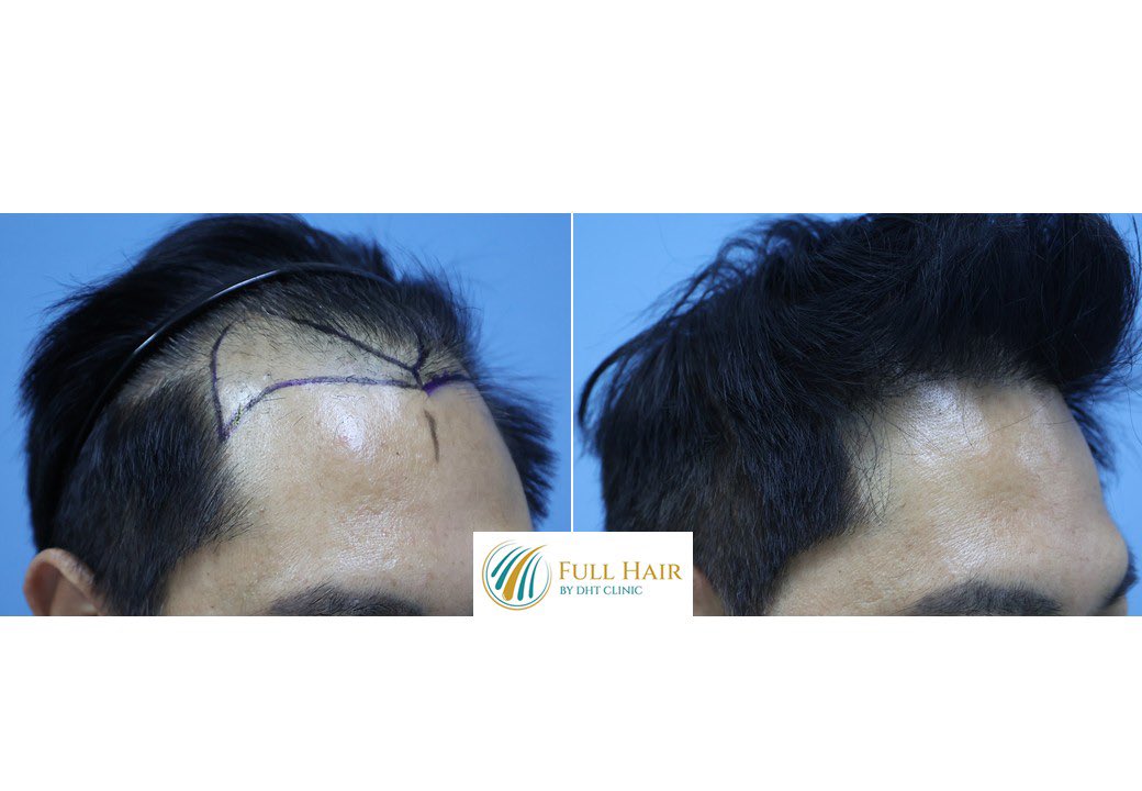 pasuoat's tweet photo. 1 year result with FUE hair transplant (2,050 grafts) , Full Hair by DHT clinic, Thailand https://t.co/sXVnoH1Gbw