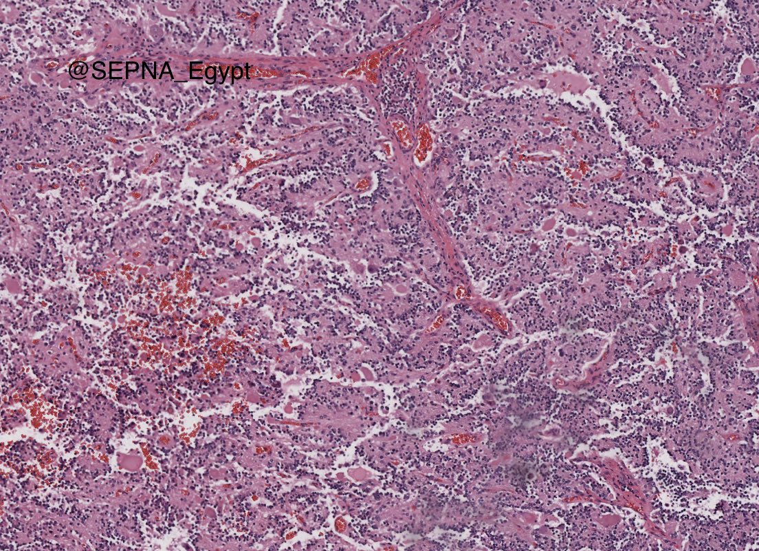 SEPNA_Egypt's tweet image. Our first interesting case of the week!
Young male with an incidental adrenal mass, what’s your diagnosis/DD?
Answer on Wednesday!
#PathTwitter 
#Pathology 
#PathX 
#SEPNA