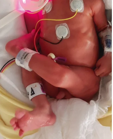 Boletin_HIMFG's tweet image. Why does early diagnosis matter in congenital #KneeDislocation?

A 20-year study from @HUCA_Asturias reveals key insights:
✔️75% of cases occur in females
✔️Incidence: 0.02%
✔️Left knee predominance

Read more 👇
👉bmhim.com/frame_esp.php?…