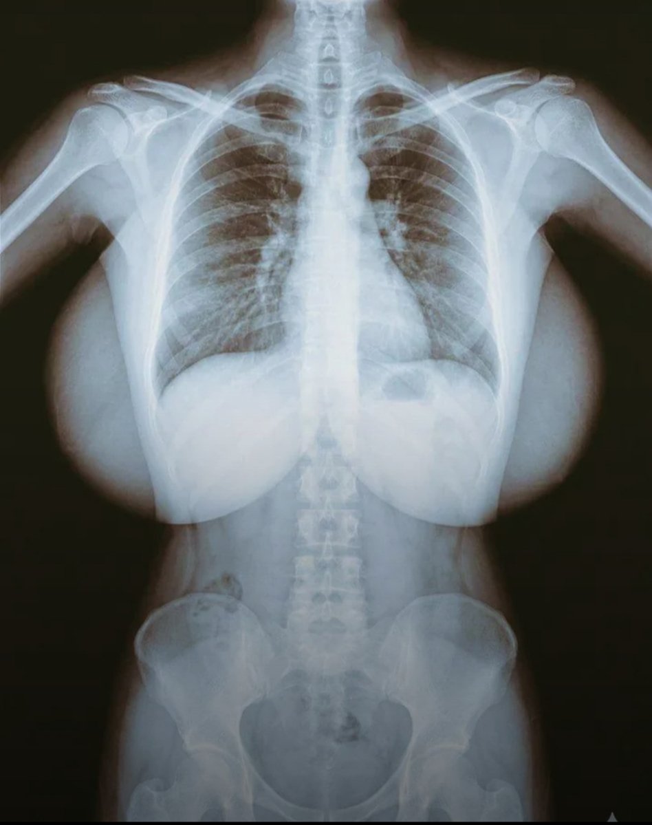 urfavchapter's tweet photo. @DormaUlly km kalo kena x-ray : https://t.co/BRFrLuy4Mz