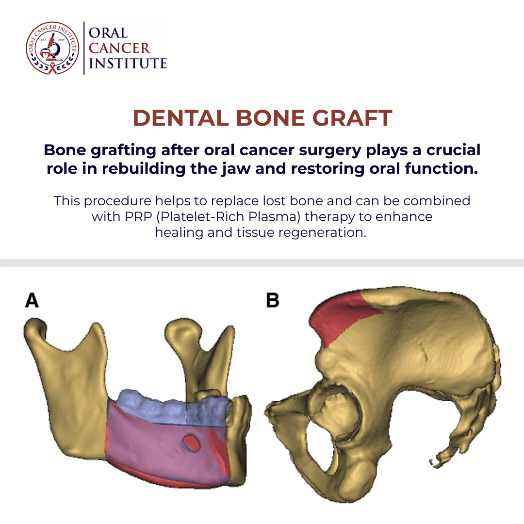 oralcancer_IL's tweet image. Bone grafting after benign jaw tumor surgery is key to restoring oral function, replacing lost bone, &amp;amp; ensuring optimal recovery. 

At OCI, we offer tailored care for the best outcomes. Learn more: ☎️ Call 773-245-5253. 

#BoneGrafting #OralHealth #OCI