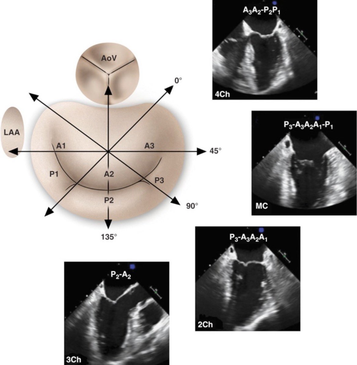 ZainKhalpey's tweet image. Mitral valve anatomy through TEE depends on probe position and angle. 

Small adjustments change the view and improve structural assessment.

@MayoClinic 

#MedTwitter #Cardiology #TEE #Echo