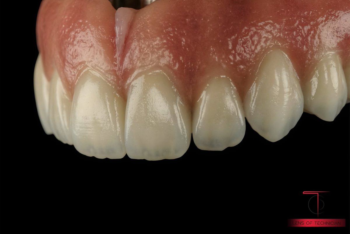 Lens_Of_Technic's tweet image. MC ceramic protocol. Inline 🌍💀
ـــــــــــــــــــــــــــــــــــــــــــــــ

 #lensofayoungtechnician #dental #dentallab #zircon #dentist 

By : 💥  Fábio França 💥