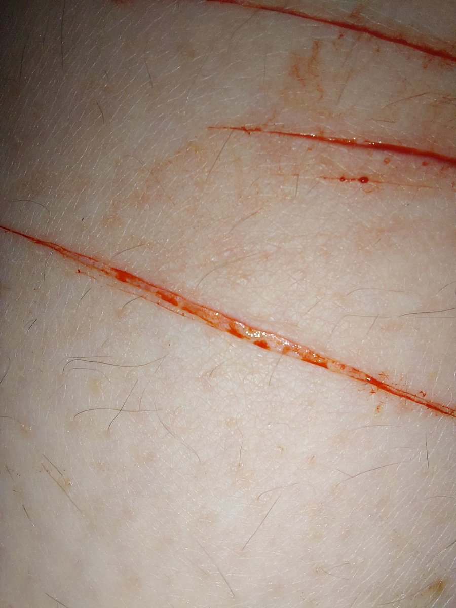 MyChemicalMind0's tweet image. some pathedic cat scrathes
all fake, its make-up

#sh 
#selfharm 
#shtwt