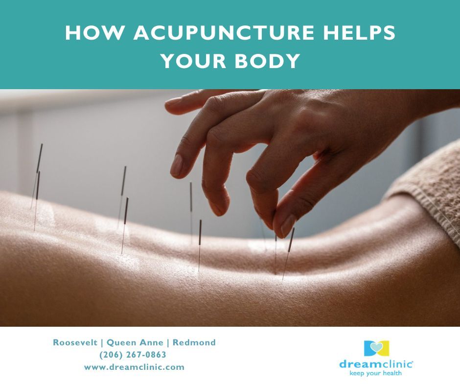 dreamclinic's tweet photo. Acupuncture accelerates healing by impacting your mood, reduces pain, increases blood circulation. ✨ 

Book your Acupuncture session today at https://t.co/5hUEqrBLKK and enjoy a $20 off your first clinic visit when you use the promo code: DCWEB20. https://t.co/sPxZGMewjw
