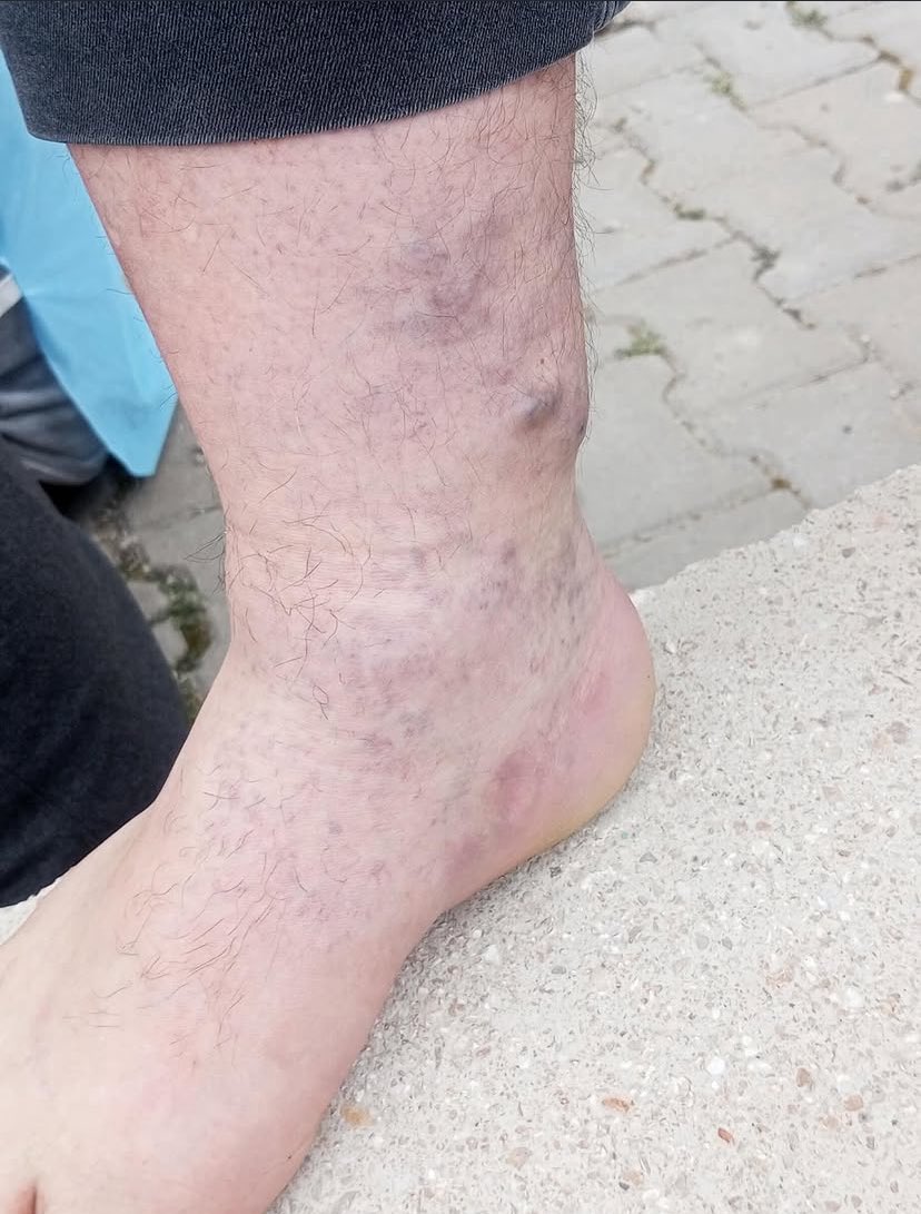 Ebrupcelik's tweet photo. Ödenmeyen ücret ve tazminat yakları için 180 kilometre yol yürüyüp, ulaştıkları Ankara'da holding sahibi bir züppe için polisten tekme, cop yiyen maden emekçilerinin ayaklarına bakın. Yerin dibine batsın sermayeniz! https://t.co/2r2vqMbHSj