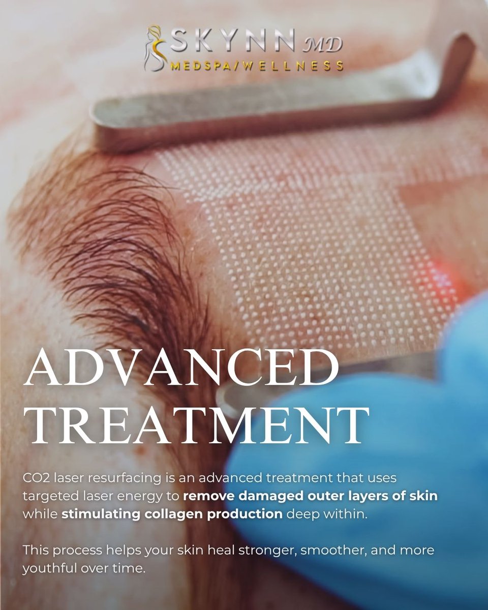 SkynnMD's tweet image. Reveal smoother, brighter, more youthful-looking skin ✨

 Swipe through to learn! 

 #CO2Laser #SkinResurfacing #LaserTreatment #AntiAgingSkin #AcneScars SkinRejuvenation MedspaResults GlowingSkin SkynnMD AdvancedAesthetics