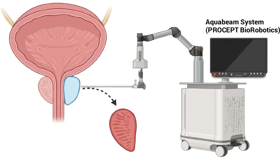 yoursexmedjour's tweet image. Sexual and urinary outcomes of minimally invasive surgical therapies for #LUTS / #BPH : a narrative review 👉 rdcu.be/feu5m

@ahmettevfikal @drserefoglu