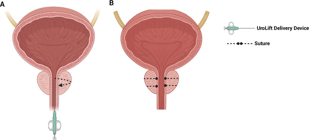 yoursexmedjour's tweet image. Sexual and urinary outcomes of minimally invasive surgical therapies for #LUTS / #BPH : a narrative review 👉 rdcu.be/feu5m

@ahmettevfikal @drserefoglu