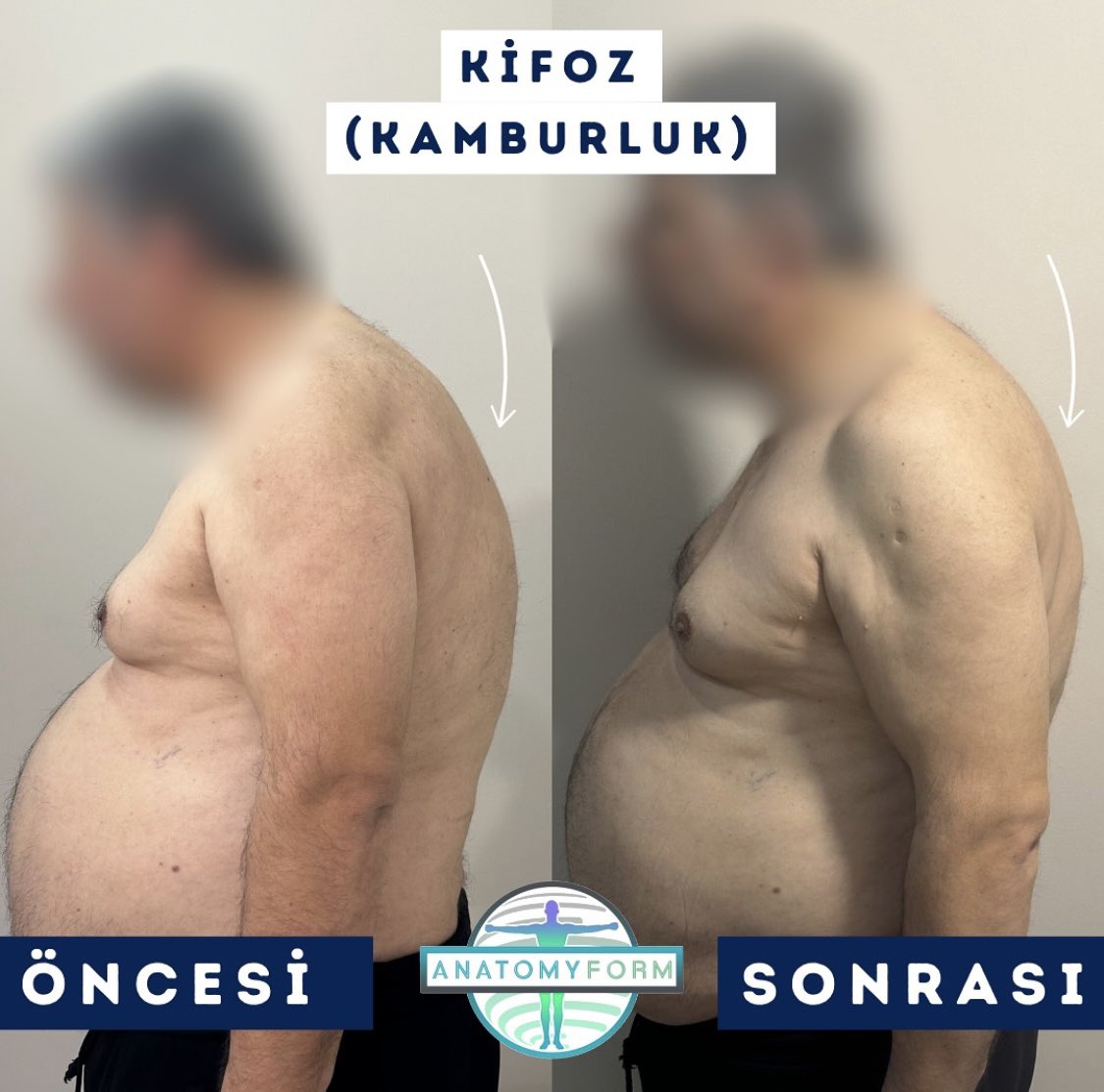 anatomyform's tweet photo. 📌DETAYLI BİLGİ ALMAK VE RANDEVU OLUŞTURMAK İÇİN İLETİŞİM NUMARAMIZI ARAYABİLİRSİNİZ.
🇹🇷 +90 544 105 05 44
#fonksiyoneltıp #fizyoterapi #manuelterapi #kifoz #kamburluk https://t.co/u2h7jEpEvq