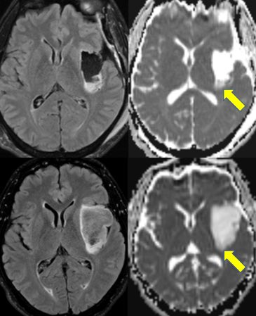 daniel_gewolb's tweet image. 💡 Tip: ADC map can be very helpful finding residual tumor on immediate post op MRI for NON-ENHANCING glioma 👇 

🔷Tips in 🧵 

@Radiopaedia #MRI #oncology #radres #futureradres #medicine #neurology #radiology #neurosurgery #ENT