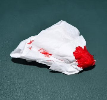 elcodigomental's tweet photo. SIGNOS DE PRESIÓN ARTERIAL ALTA

1. Hemorragia nasal. https://t.co/adEQpRemfp