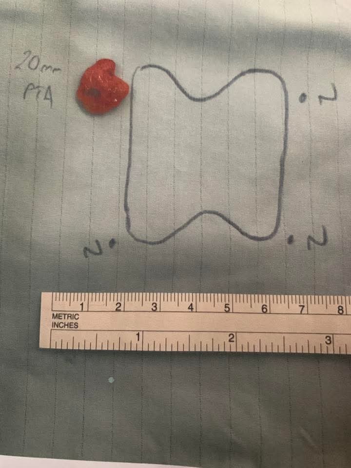 SpSallie's tweet image. The NHS often refuses to test PTH if calcium is within normal range. NG132 recommends no further investigations if calcium is &amp;lt;2.6. A lady had to borrow £6500 to pay privately to have this 2cm #parathyroid adenoma removed. She was robbed by #NG132 &amp;amp; #NHS calcium 2.48, PTH 11.2