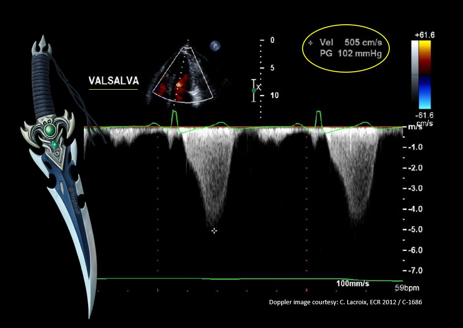 NephroP's tweet image. Classic image of the day!
#POCUS #FOAMed #Nephpearls