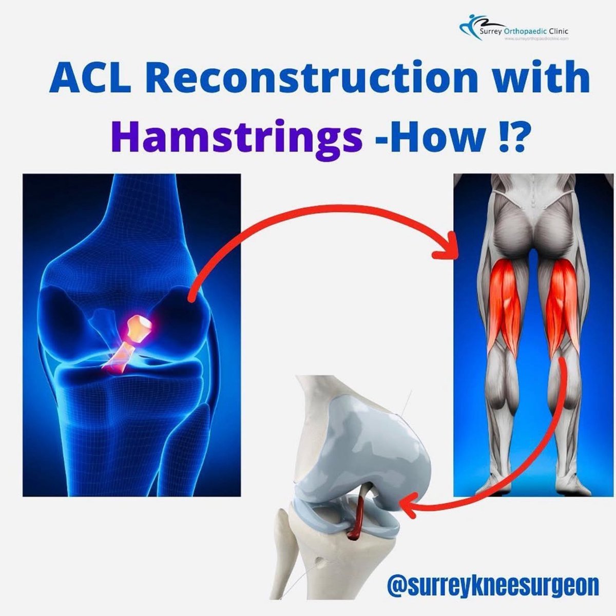 PhysioOsteoGram's tweet photo. ACL RECONSTRUCTION WITH HAMSTRINGS

How do you we turn your hamstring into your ACL?

Where do we take your hamstring from and how do we take it out? 

How do we construct a ‘new’ ACL with your hamstring?

Check this post!

https://t.co/CKdVfXhKH9 https://t.co/6PtPRBB1k7