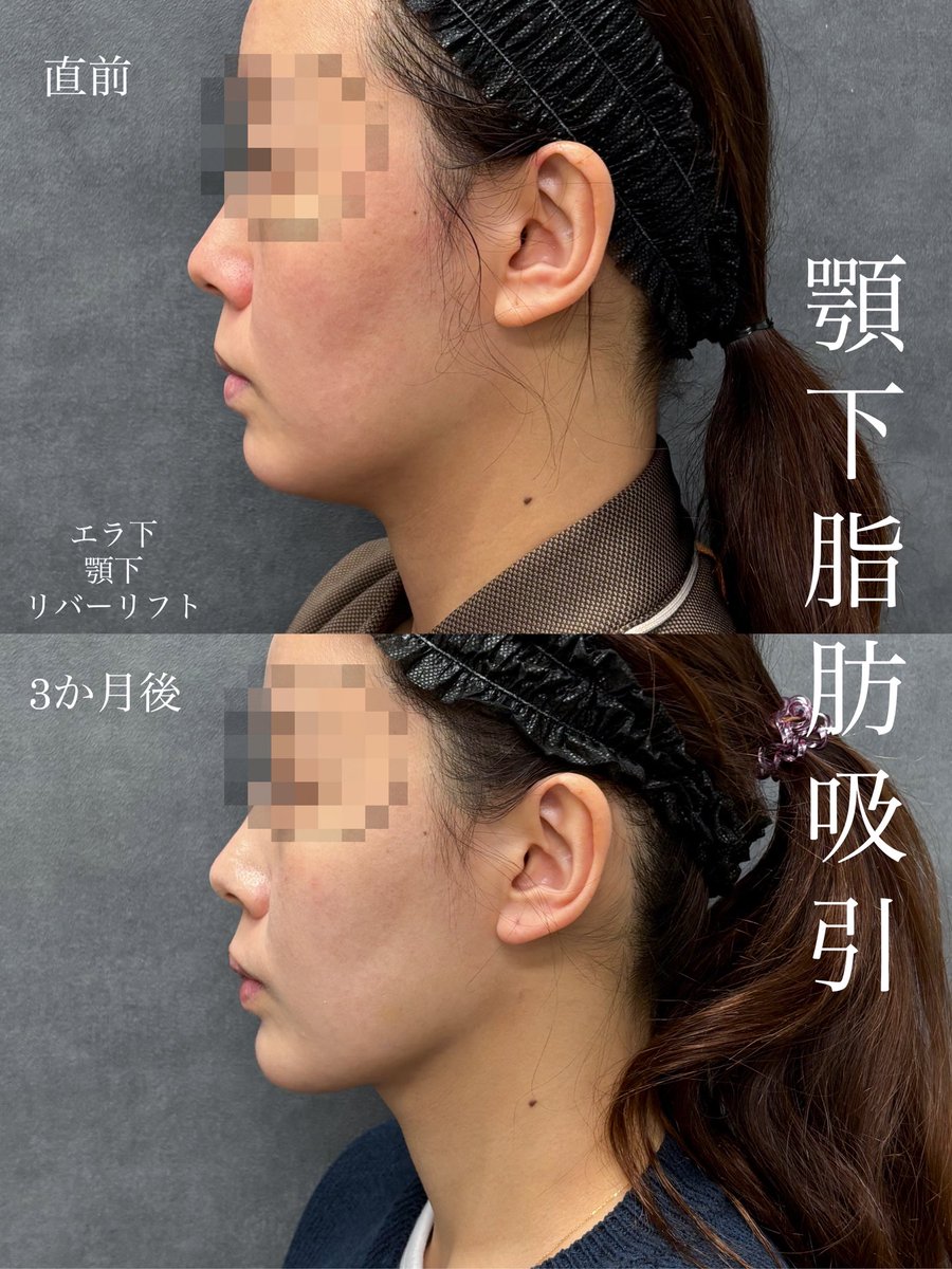 dr__kiya's tweet photo. 【顎下脂肪吸引　3か月後症例】
他人から見られる場合は横からが多いです。横顔で整っているのは美人の必須条件ですね✨
顎ヒアルロン酸も併用するとよりシャープな輪郭に仕上がります！
日々沢山の方に満足していただいている施術です🙏
また、DTとれない！という方にも沢山ご来院いただいてます🙇‍♀️ https://t.co/ipld8TwjtI