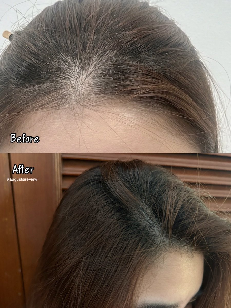 augustsi2's tweet image. เคยผมมีรังแคผมบางไม่รู้ตัว กัสเรื่องเยอะกับยาสระมากจนมาเจอ #Clear ตัวนี่เค้ายกระดับไปอีกขั้น Scalpceuticals Pro ช่วยลดต้นเหตุของรังแค ตอนนี้ที่หัวไม่ค่อยมีแล้ว นี้ใช้สูตร Dandruff Rescue (สีฟ้า) ยาสระที่ดี ผมต้องไม่มันเร็ว สระแล้วผมยังสุขภาพดี ไม่กระด้าง มีวอลลุม แนะนำเลย ✨