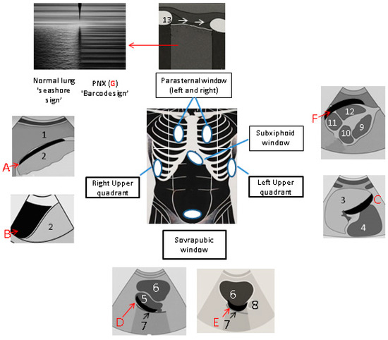 JCM_MDPI's tweet image. #mdpijcm 
Check out #2025ReviewPaper
✅ Citations 12
Extended Focused #Assessment with Sonography for #Trauma in the #Emergency Department
👉mdpi.com/3312936
@MediPharma_MDPI
#echocardiography; #criticalcare; #pleuraleffusion; #bluntabdominaltrauma; #ultrasound
