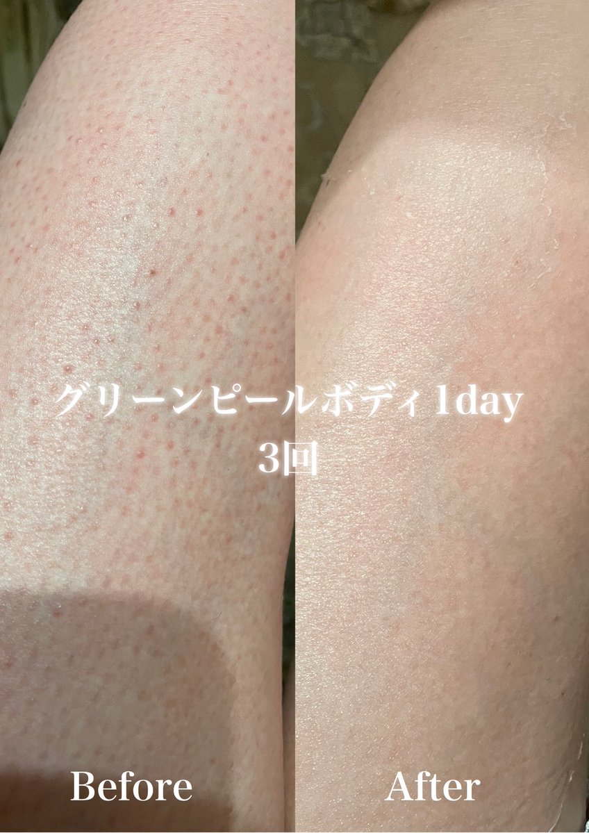 二の腕、背中、足のぶつぶつ、ザラザラが気になる😢と10代のお客様が急増しております。

「なんにも気にせずお洋服を選びたい！」

その気持ちに早く応えたい、綺麗な素肌を楽しんでいただきたい
ぜったいぜったい綺麗に仕上げますよ✊🏻

#チキンスキン
#毛孔性苔癬
#角化症