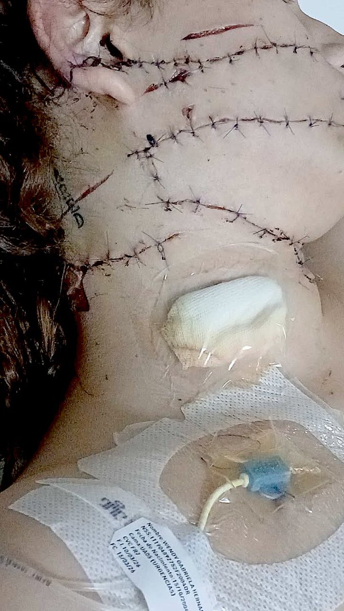 🇲🇽 | Wendy Gabriela N permanece luchando por su vida tras ser atacada con un arma blanca por Pedro Jared Pomposo el pasado martes 10 de marzo en Ecatepec. El sujeto, quien se desempeña como enfermero en el Hospital General de Xalostoc, la agredió repetidamente tras una discusión