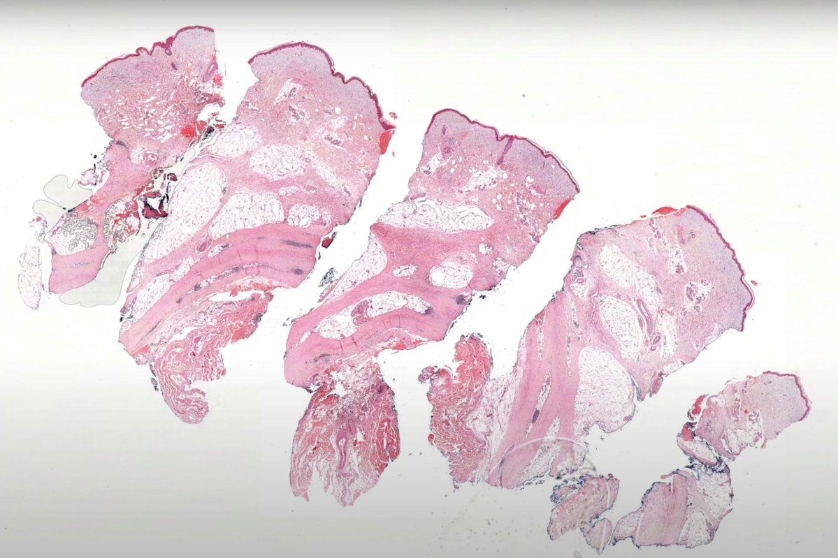 JMGardnerMD's tweet image. Young adult with hard indurated bound-down skin on bilateral legs. 
Answer ✅ youtu.be/4PhO81EeGa0 
Digital slide: kikoxp.com/posts/24168 
Another rare disease that can mimic this clinically 👉 youtu.be/ejj69LOagJE 
#pathology #pathologists #pathTwitter #dermpath