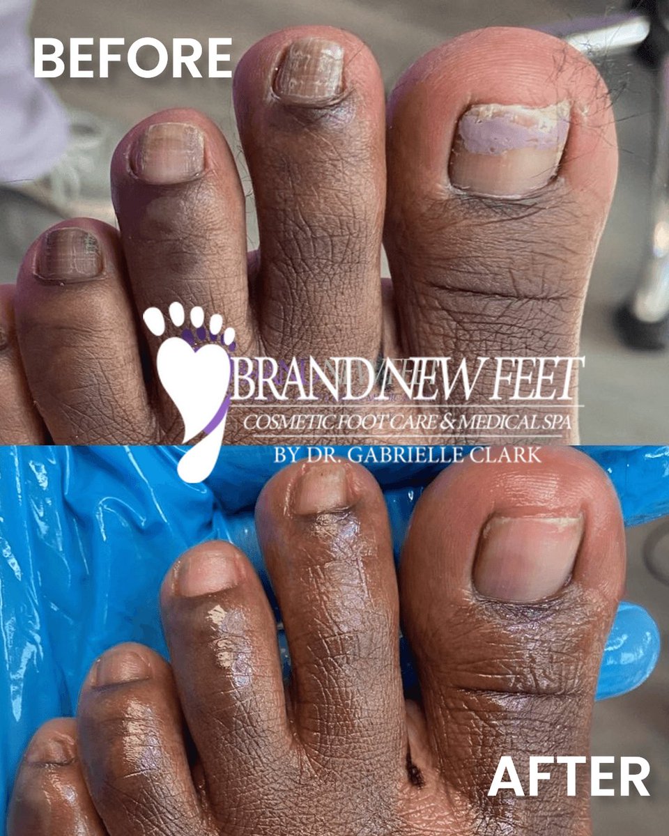 mybrandnewfeet's tweet image. Healing is not linear but it is possible. 🦶💜 

Consistent Medical Pedicure care at Brand New Feet transforms damaged nails step by step. 

Book today! 
📞 (504) 475-FEET (3338) | brandnewfeet.com

 #BrandNewFeet #FootHealth #Heal #Pedicure #spa #foryou