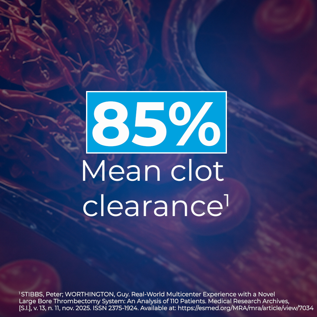 ArgonMedical's tweet image. 110 procedures were evaluated in a new multicenter, retrospective analysis of the CLEANER Vac® #Thrombectomy System.

The study highlights real-world experience with CLEANER Vac in the treatment of venous thrombosis, including clot clearance outcomes and procedural insights.